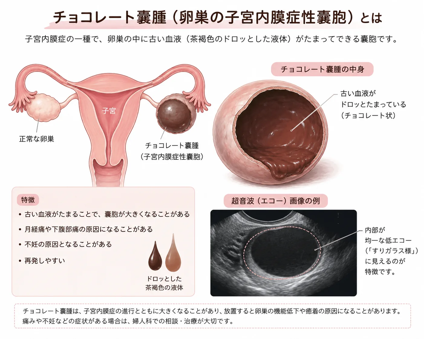 チョコレート嚢胞（卵巣の子宮内膜症性嚢胞）の解説図。卵巣に古い血液がたまる仕組みと超音波画像の例