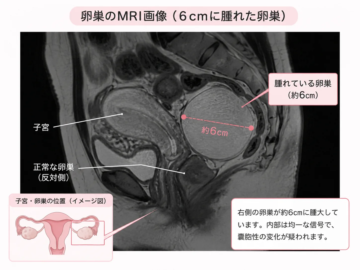 卵巣のMRI画像の解説図。右卵巣が約6cmに腫大し、嚢胞性の変化が疑われる所見