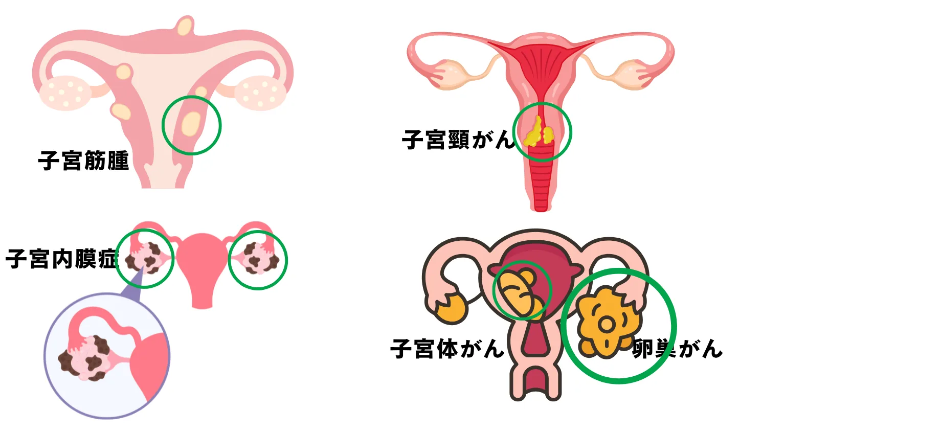 経腟エコーで見つかる病気（子宮筋腫・子宮頸がん・子宮内膜症・子宮体がん・卵巣がん）を示したイラスト