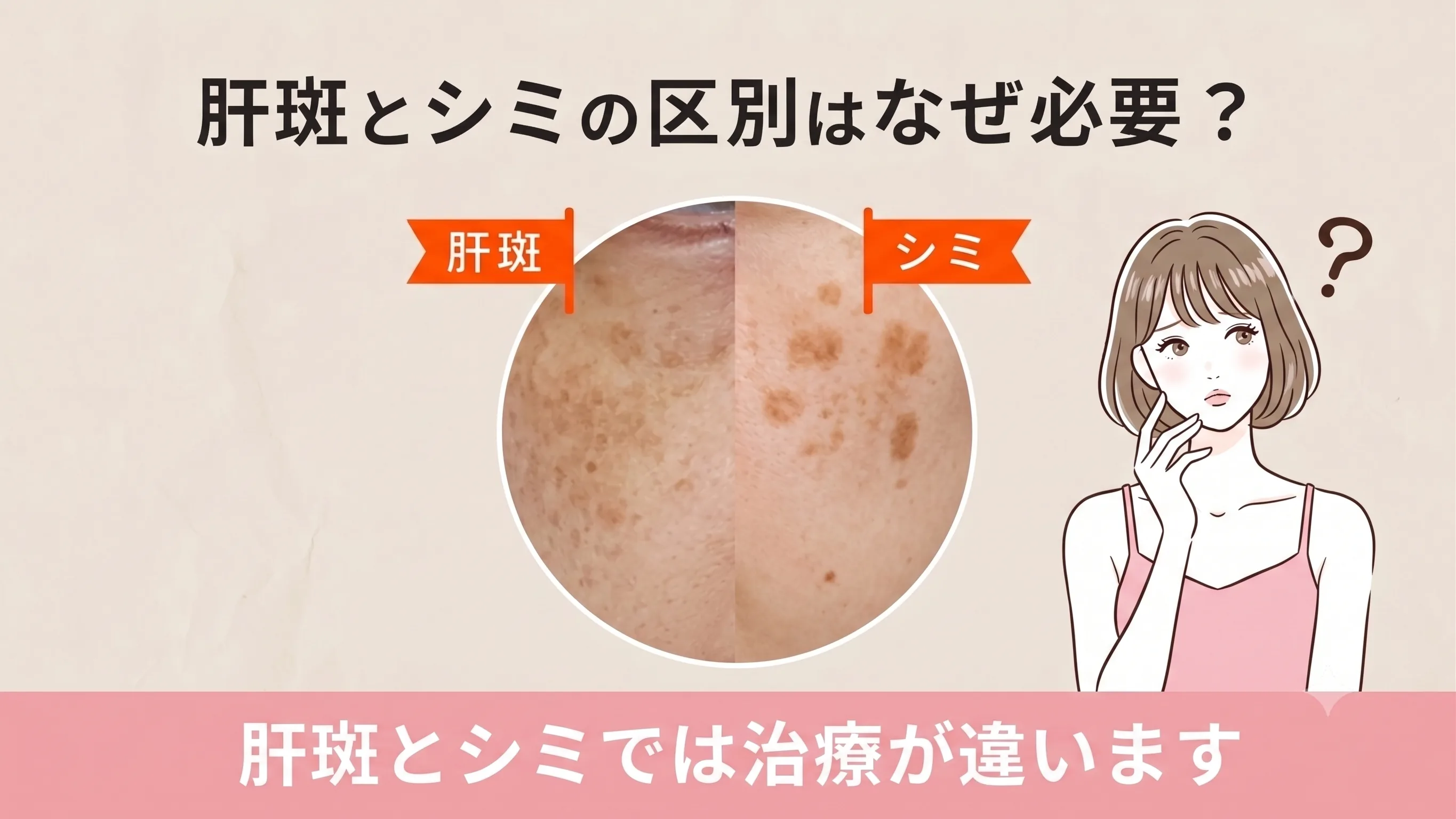 頬骨のあたりに左右対称にできる肝斑の特徴を示した解説イラスト