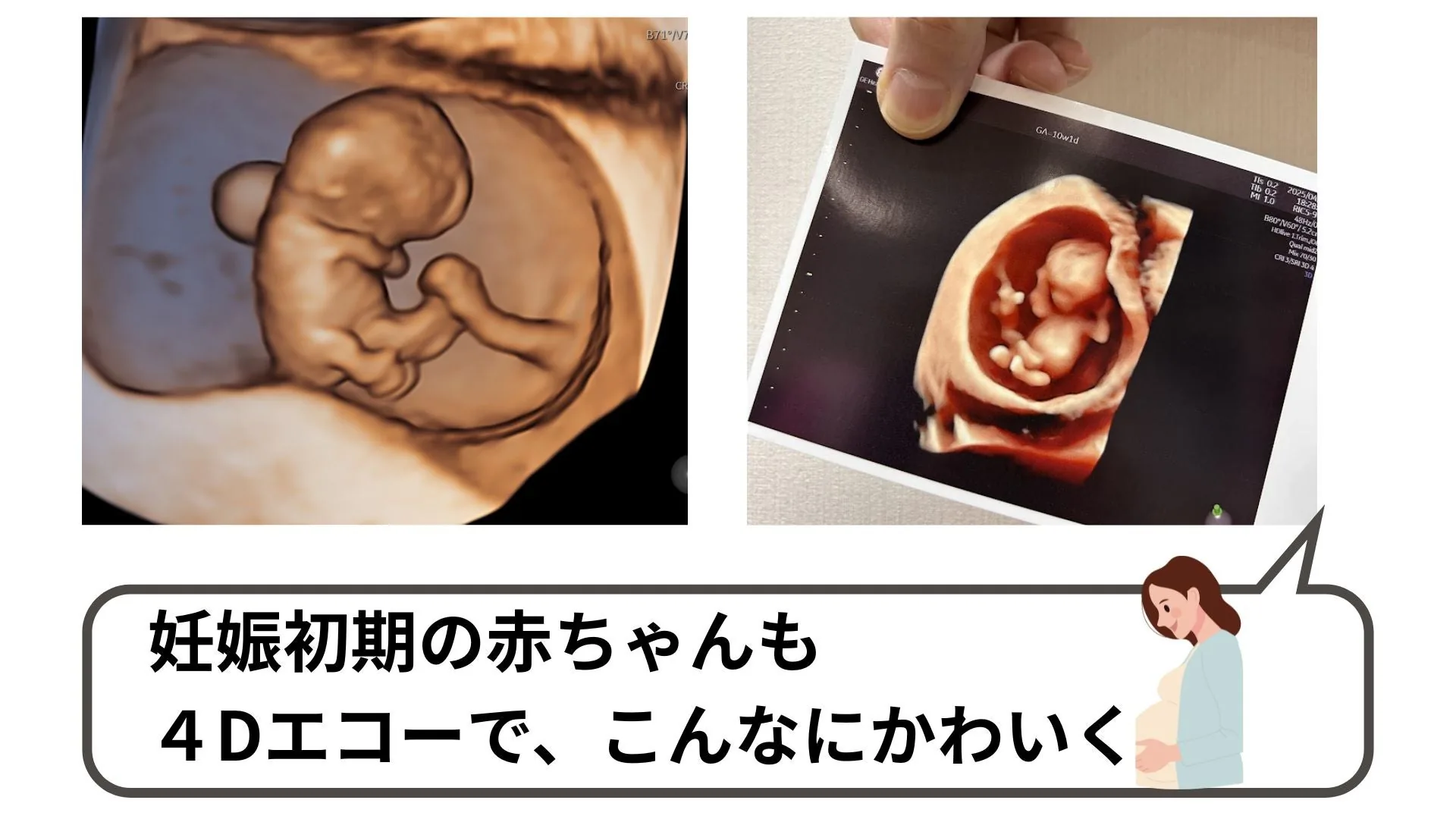 妊娠初期の赤ちゃんの4Dエコー画像と4Dエコー写真