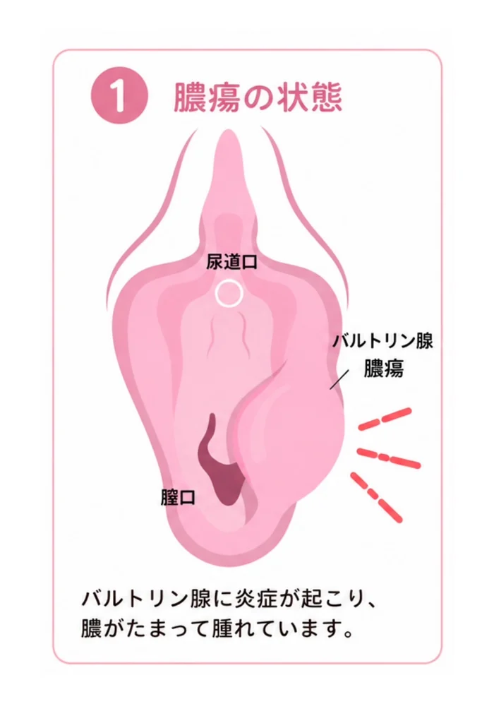 バルトリン腺膿瘍の切開術・造袋術 ①膿瘍の状態：バルトリン腺に炎症が起こり、膿がたまって腫れている状態を、尿道口・膣口・バルトリン腺膿瘍の位置とともに示した図。