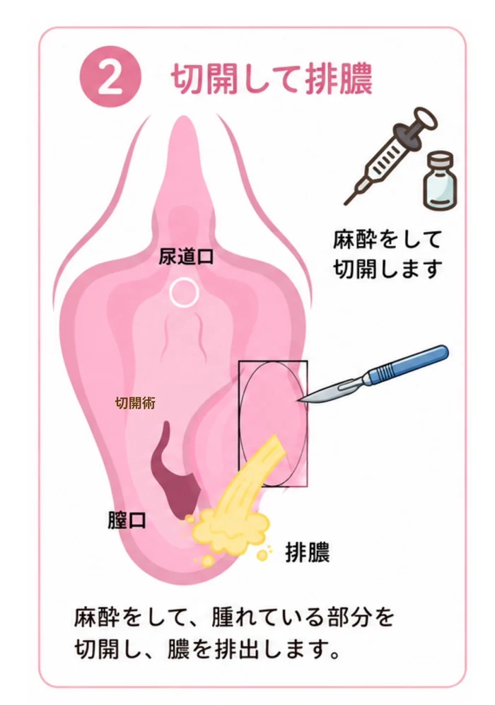 バルトリン腺膿瘍の切開術・造袋術 ②切開して排膿：麻酔をして、腫れている部分を切開し、たまった膿を排出する様子を示した図。