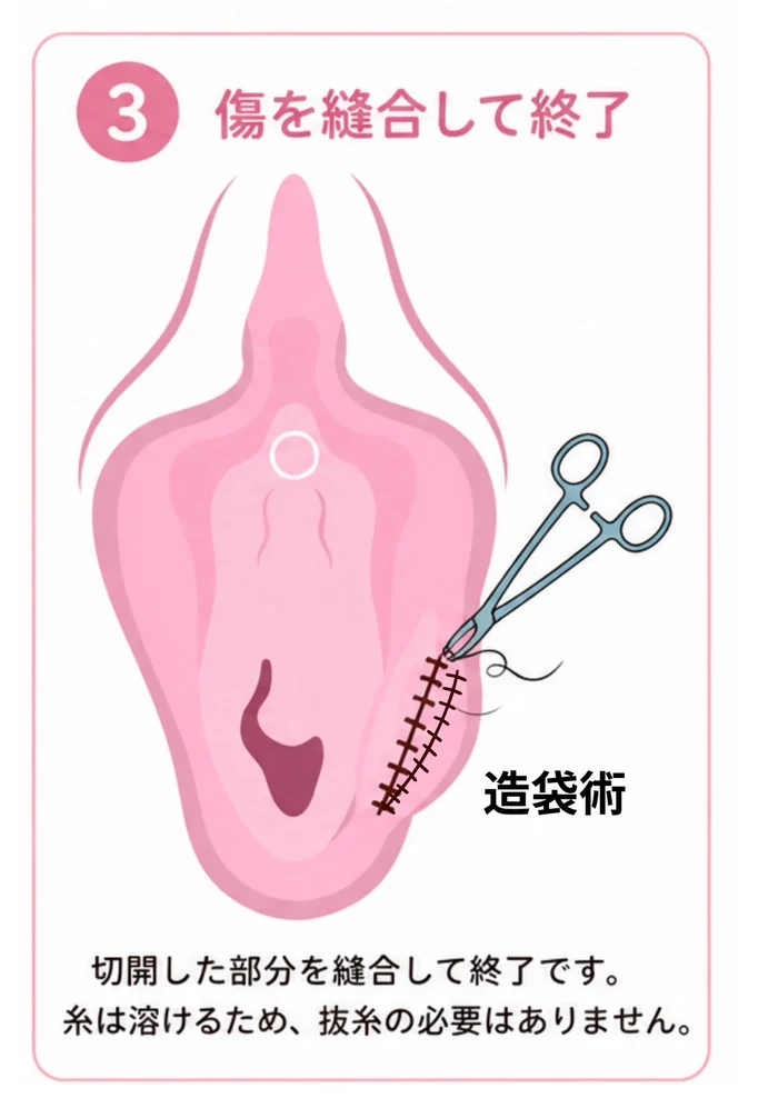バルトリン腺膿瘍の切開術・造袋術 ③傷を縫合して終了（造袋術）：切開した部分を縫合して終了。糸は溶けるため抜糸の必要はないことを示した図。