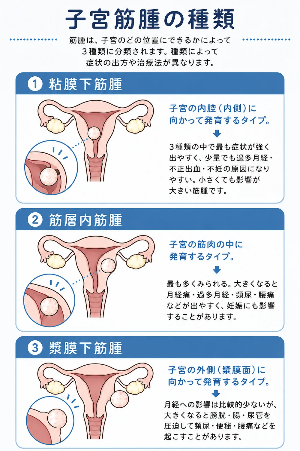 子宮筋腫の種類の図解。①粘膜下筋腫：子宮の内腔（内側）に向かって発育するタイプで、3種類の中で最も症状が強く、少量でも過多月経・不正出血・不妊の原因になりやすい。②筋層内筋腫：子宮の筋肉の中に発育する最も多いタイプで、大きくなると月経痛・過多月経・頻尿・腰痛などが出やすく妊娠にも影響することがある。③漿膜下筋腫：子宮の外側（漿膜面）に向かって発育するタイプで、月経への影響は比較的少ないが、大きくなると膀胱・腸・尿管を圧迫して頻尿・便秘・腰痛を起こすことがある。