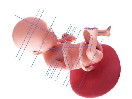 胎児の立体画像