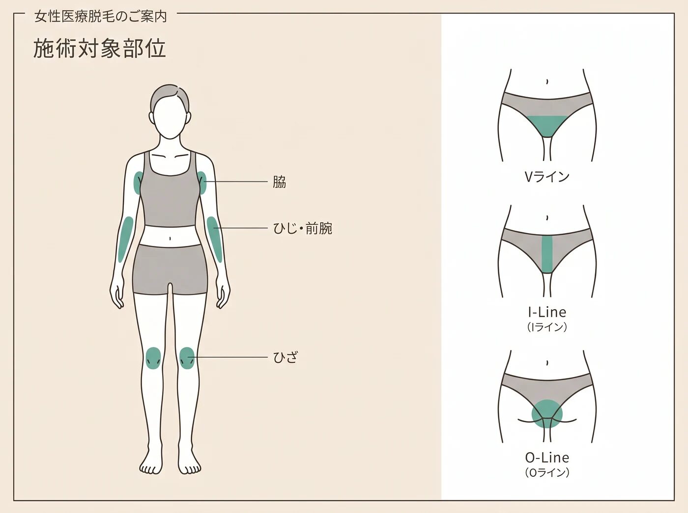 自院で施術できる脱毛部位のイラスト：脇、ひじ・前腕、ひざ、Vライン・Iライン・Oライン